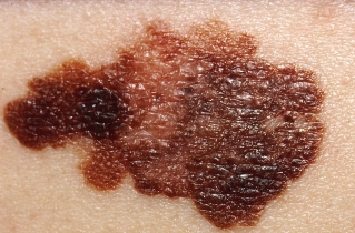 Melanoma vaccine success sparks hope for broader cancer treatment