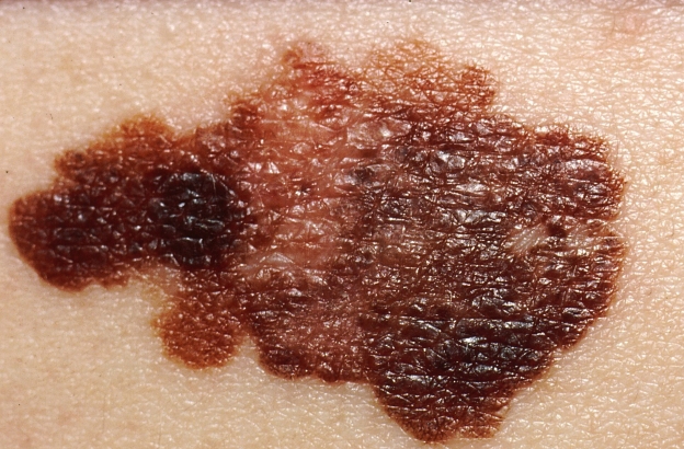Melanoma vaccine success sparks hope for broader cancer treatment
